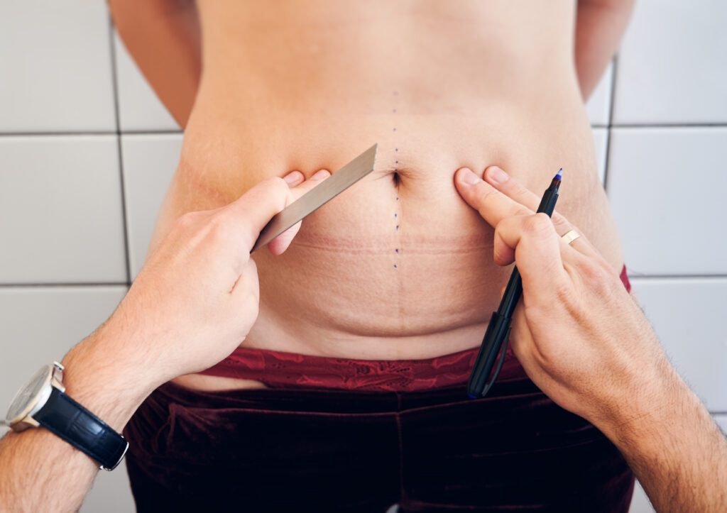 Plastic surgeon checking female abdomen before sur 2022 05 28 10 48 12 utc